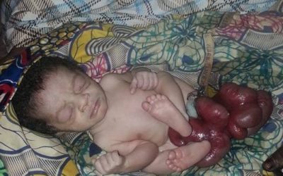 What is Gastroschisis?