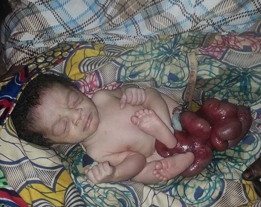 What is Gastroschisis?